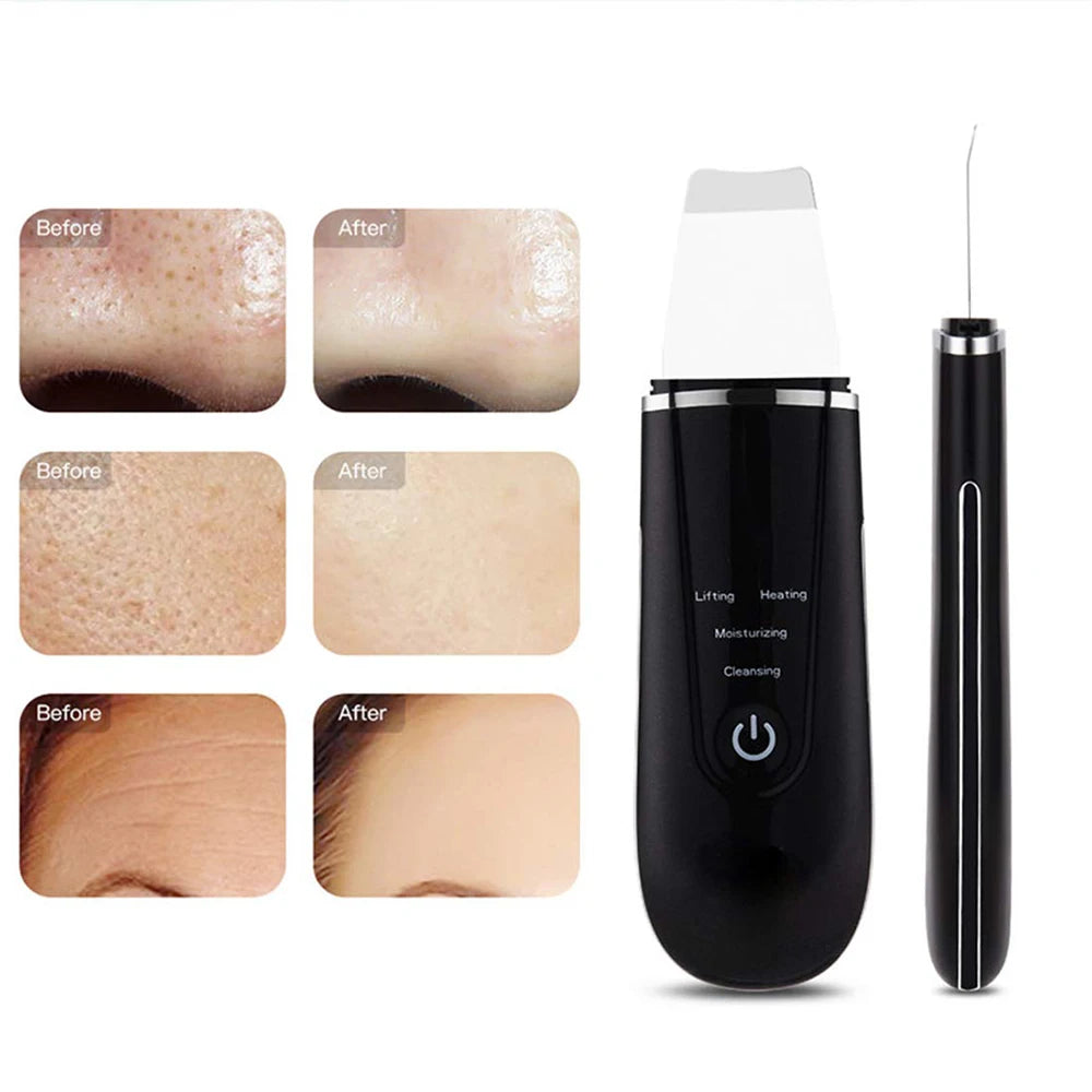 Wireless Ultrasonic Skin Scrubber – Hot Compress & Pore Care