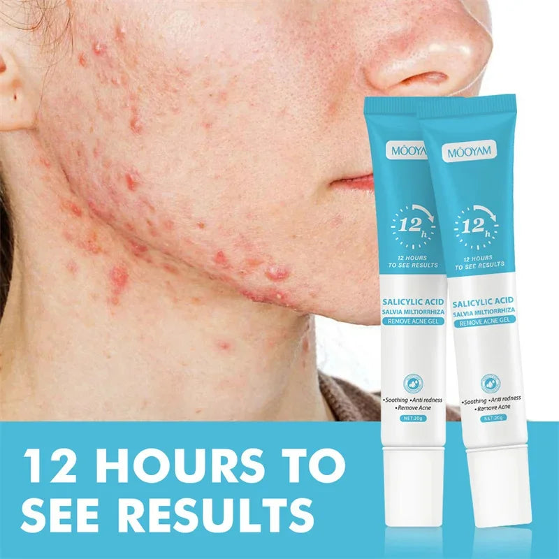 Acne Face Cream – Pimple Treatment & Oil Control Care