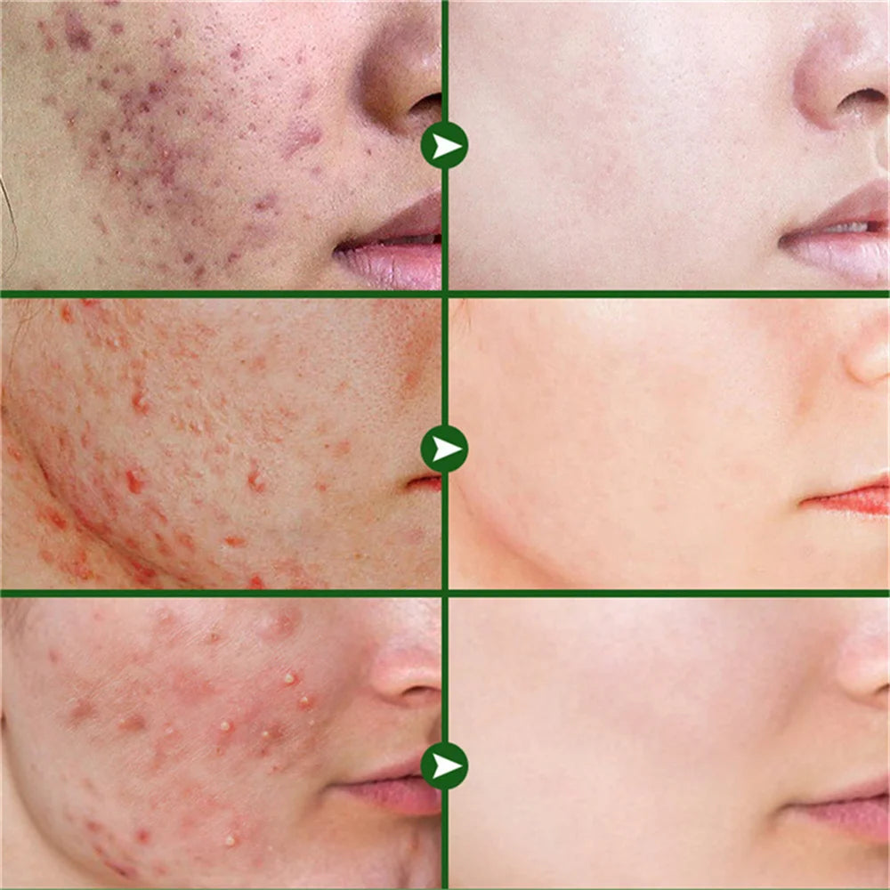 Salicylic Acid Acne Serum – Pore & Oil Control Treatment