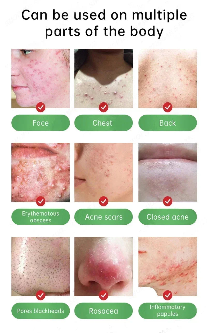 Facial Skin Peel Serum – Chemical Peel for Acne & Wrinkles