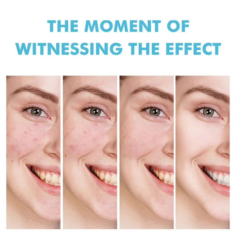 Acne Face Cream – Pimple Treatment & Oil Control Care