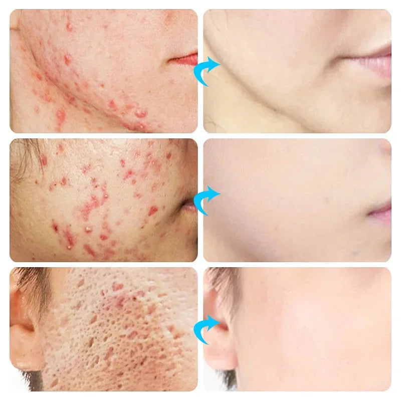 Acne Face Cream – Pimple Treatment & Oil Control Care