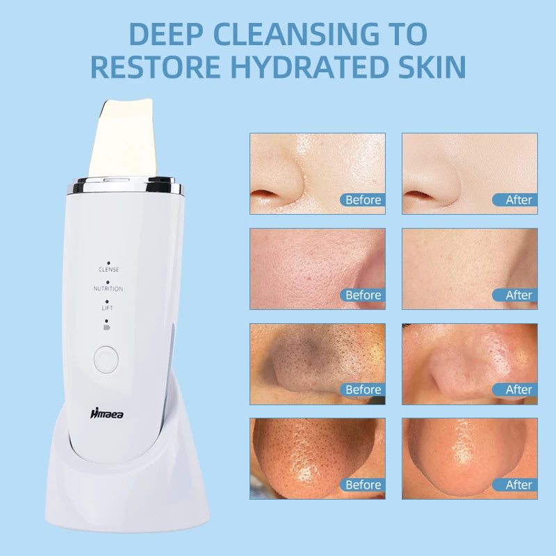 Ultrasonic Face Spatula – Blackhead & Pore Cleaner