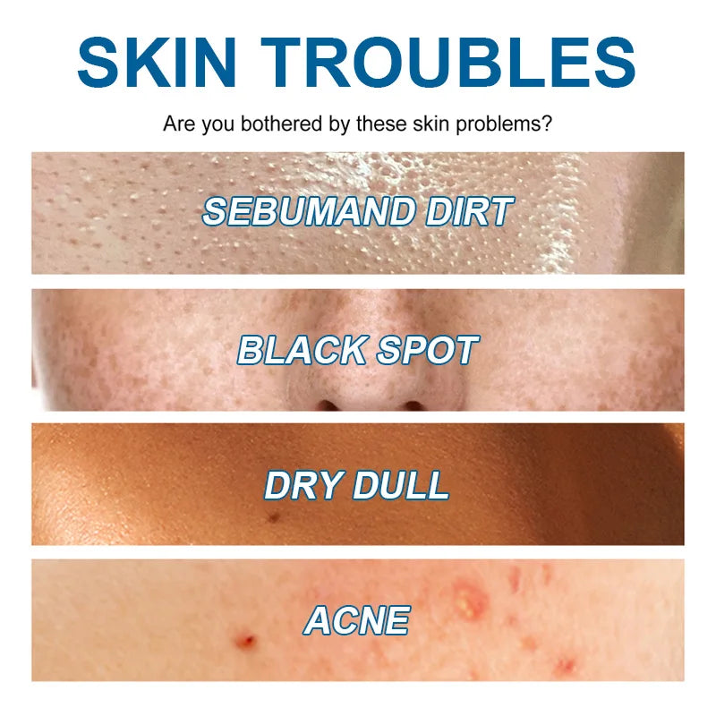 Oligopeptide Anti-Acne Serum – EGF Repair & Moisturizing