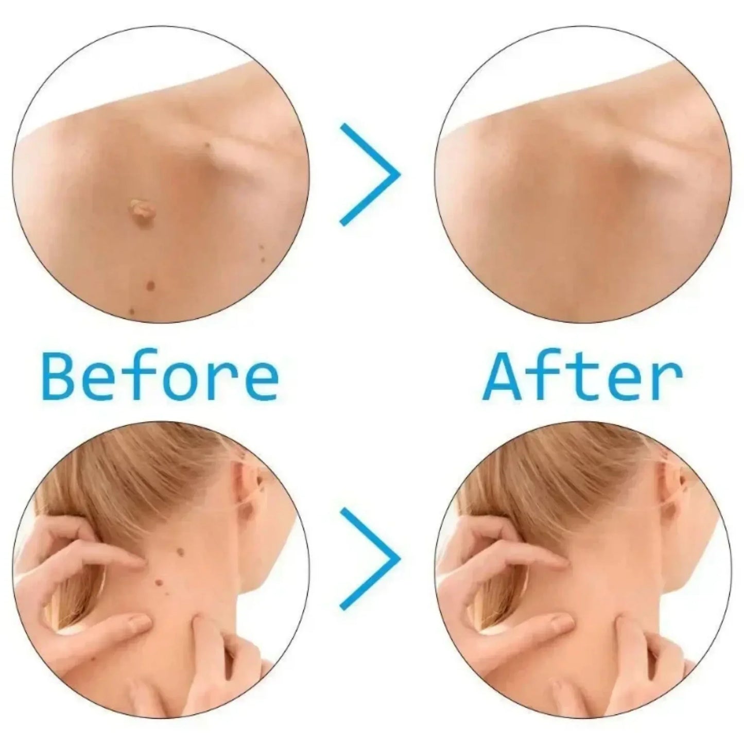 Skin Tag & Mole Removal Kit – Wart Remover with Swabs