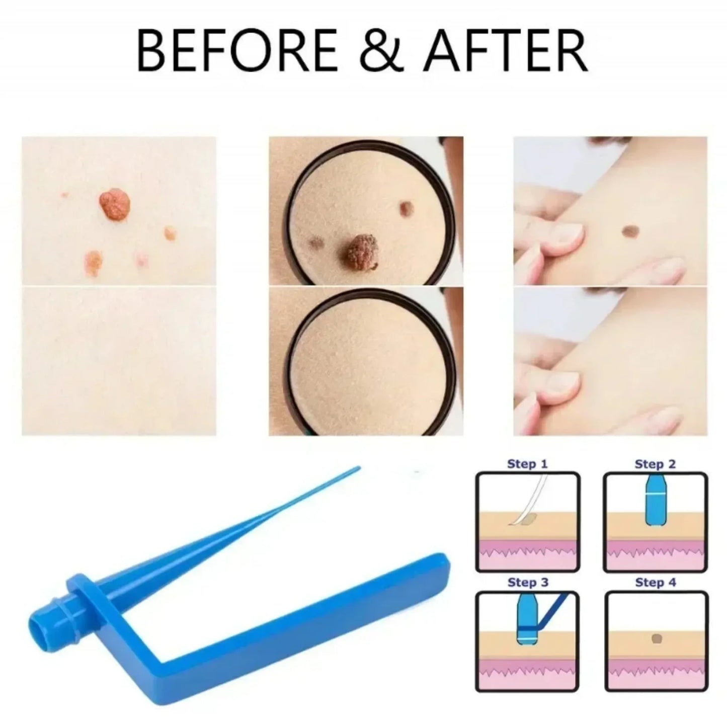 Skin Tag & Mole Removal Kit – Wart Remover with Swabs
