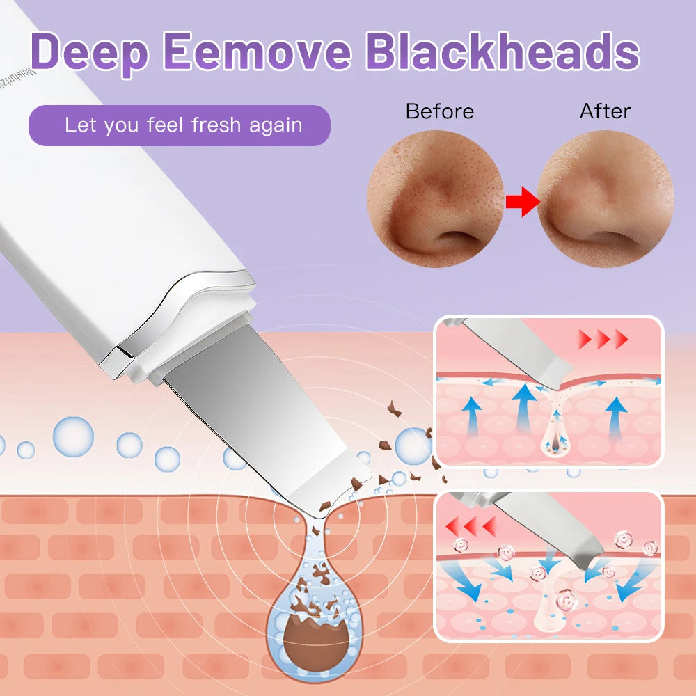 Ultrasonic Face Spatula – Blackhead & Pore Cleaner