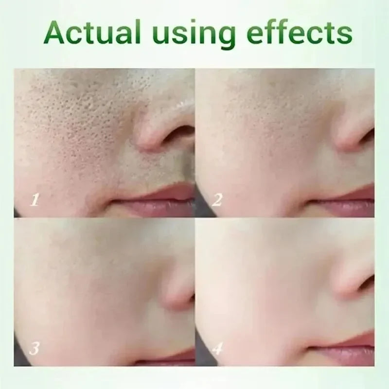 Salicylic Acid Pore Cream – Blackhead & Skin Repair Care