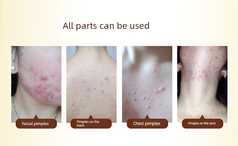 Romasin Amygdalic Acid Essence – Acne & Oil Control Serum