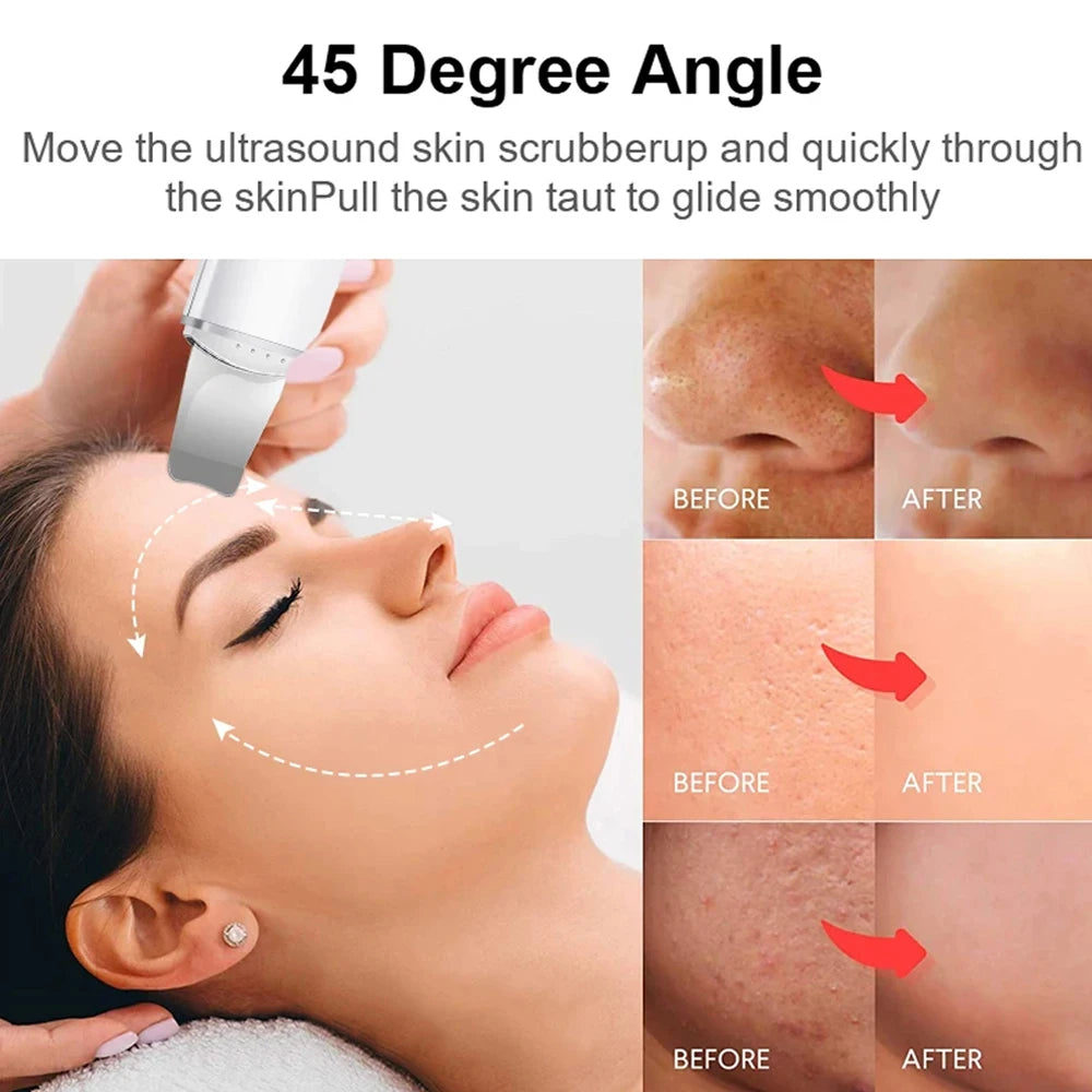Electric Skin Scrubber – Blackhead & Acne Remover