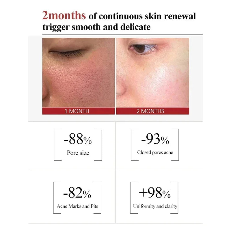 Salicylic Acid Pore Cream – Blackhead & Skin Repair Care