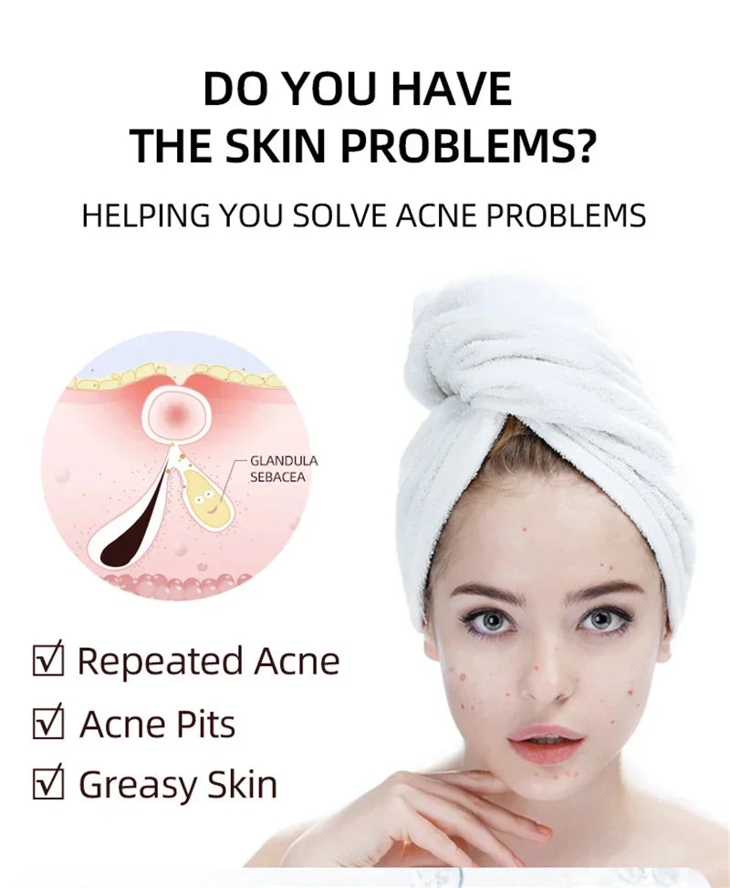 Acne Face Cream – Pimple Treatment & Oil Control Care