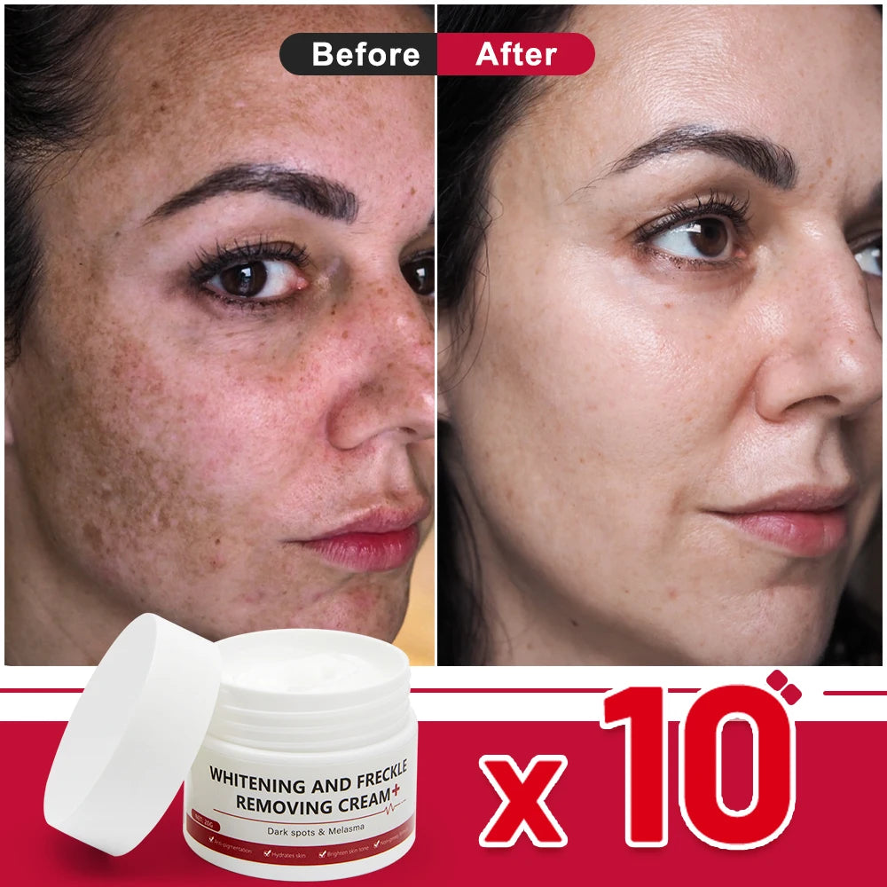 Whitening Freckle Cream – Dark Spot & Melasma Remover