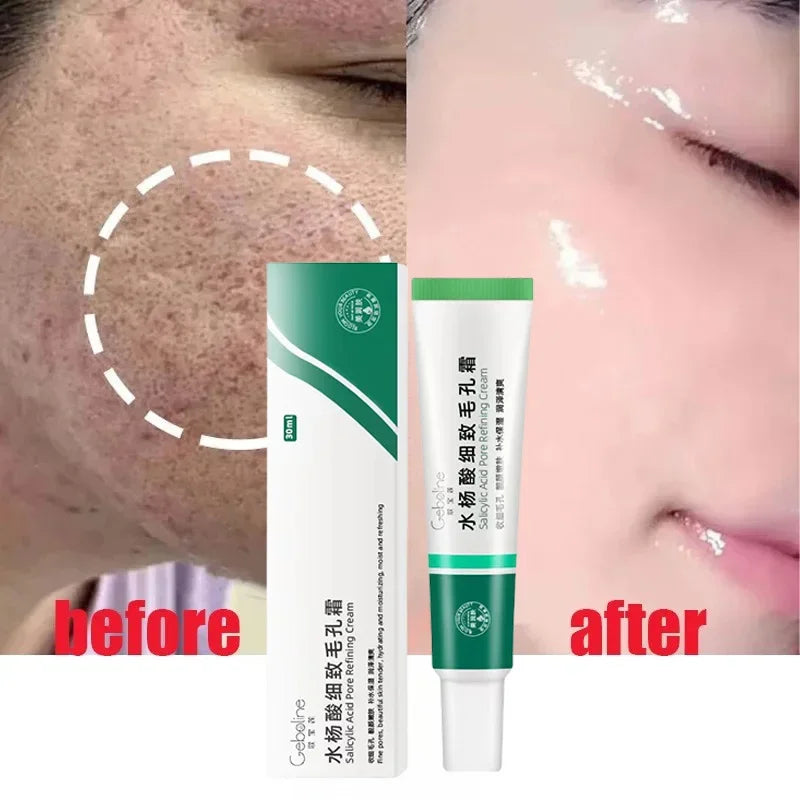 Salicylic Acid Pore Cream – Blackhead & Skin Repair Care