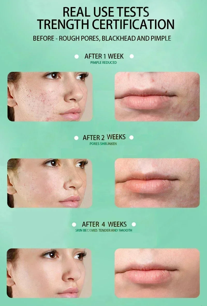 Facial Skin Peel Serum – Chemical Peel for Acne & Wrinkles