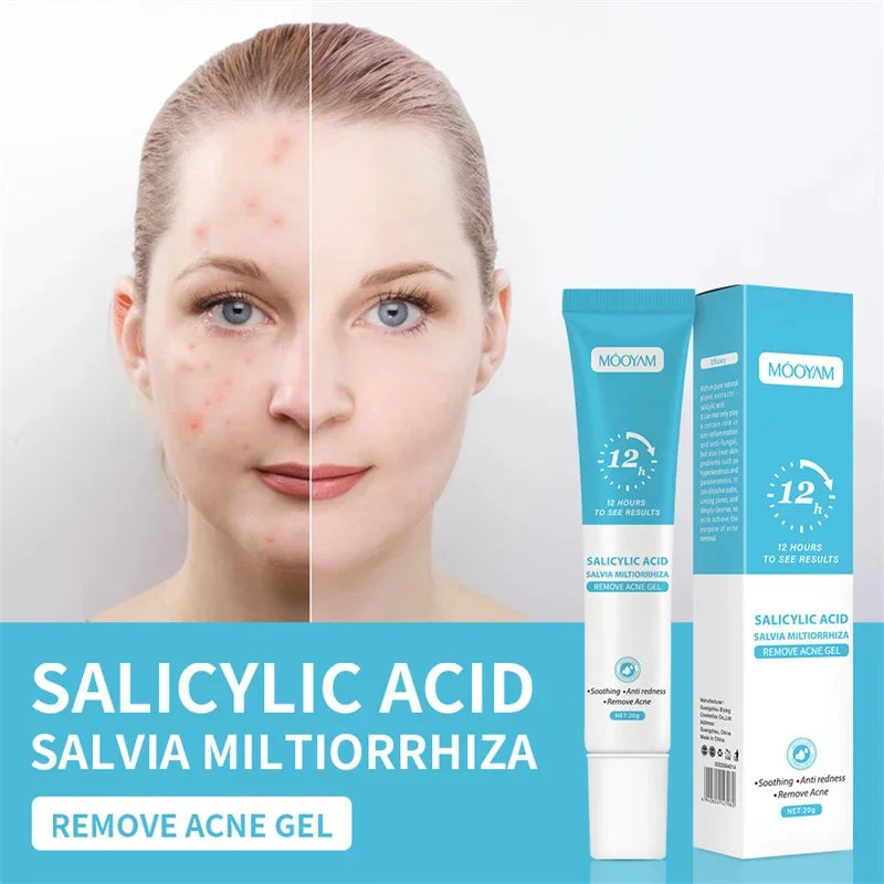 Acne Face Cream – Pimple Treatment & Oil Control Care