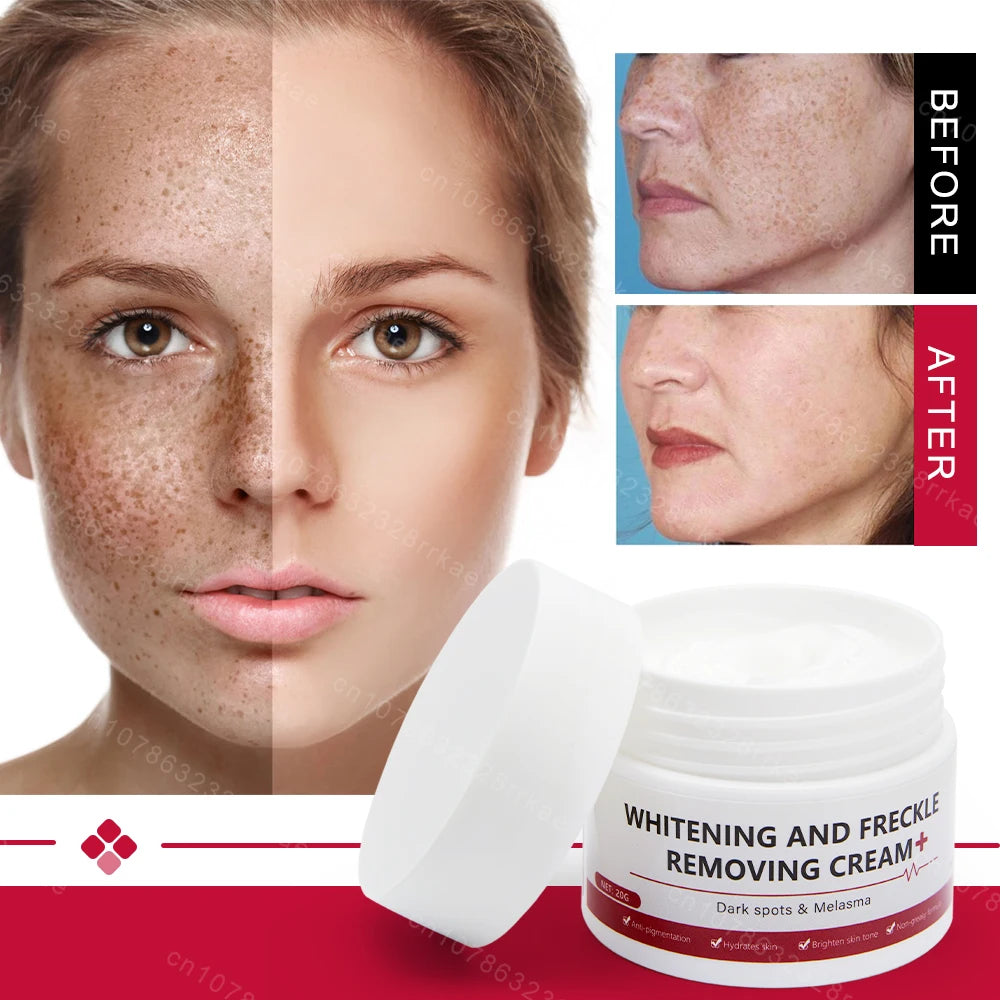 Whitening Freckle Cream – Dark Spot & Melasma Remover