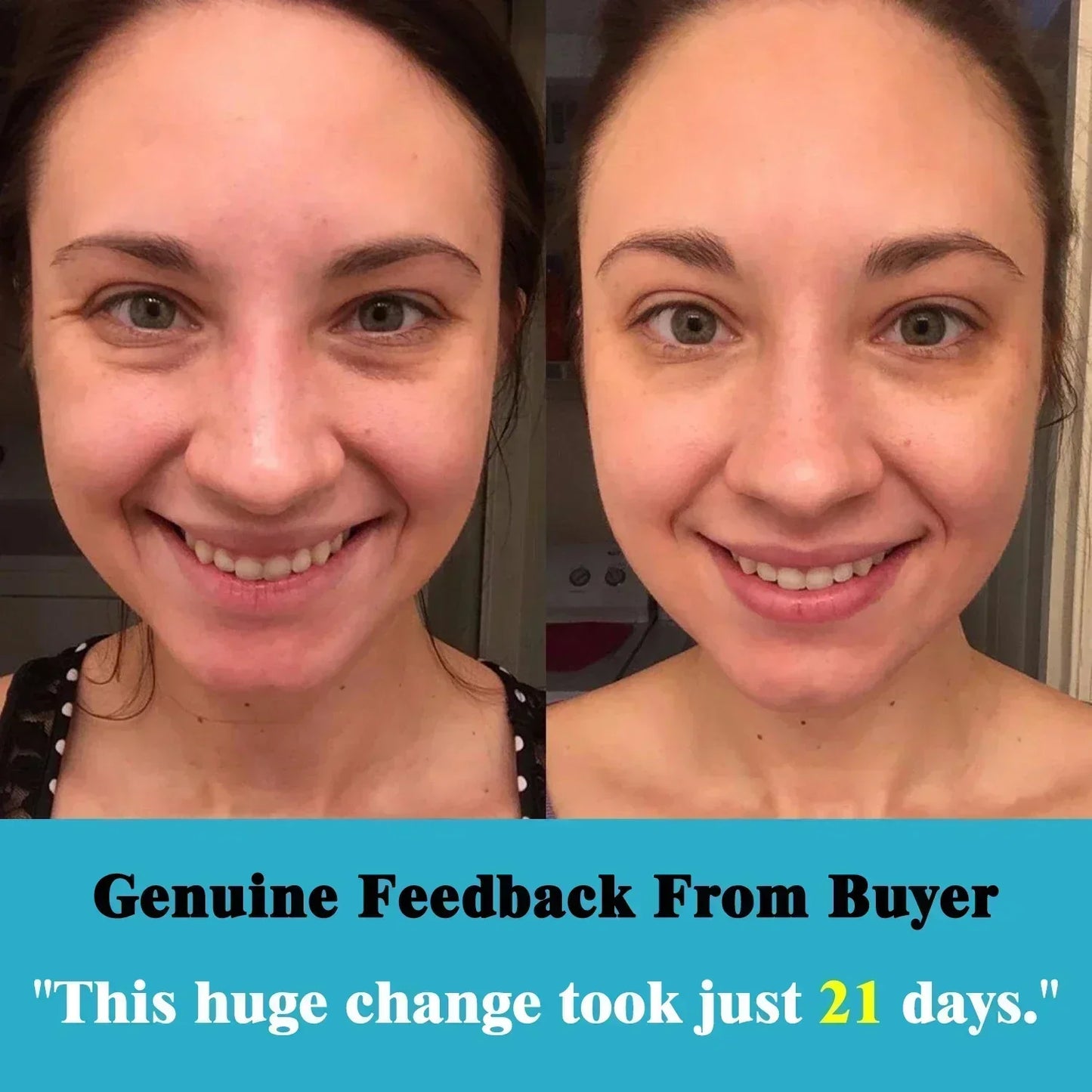 Facial Skin Peel Serum – Chemical Peel for Acne & Wrinkles