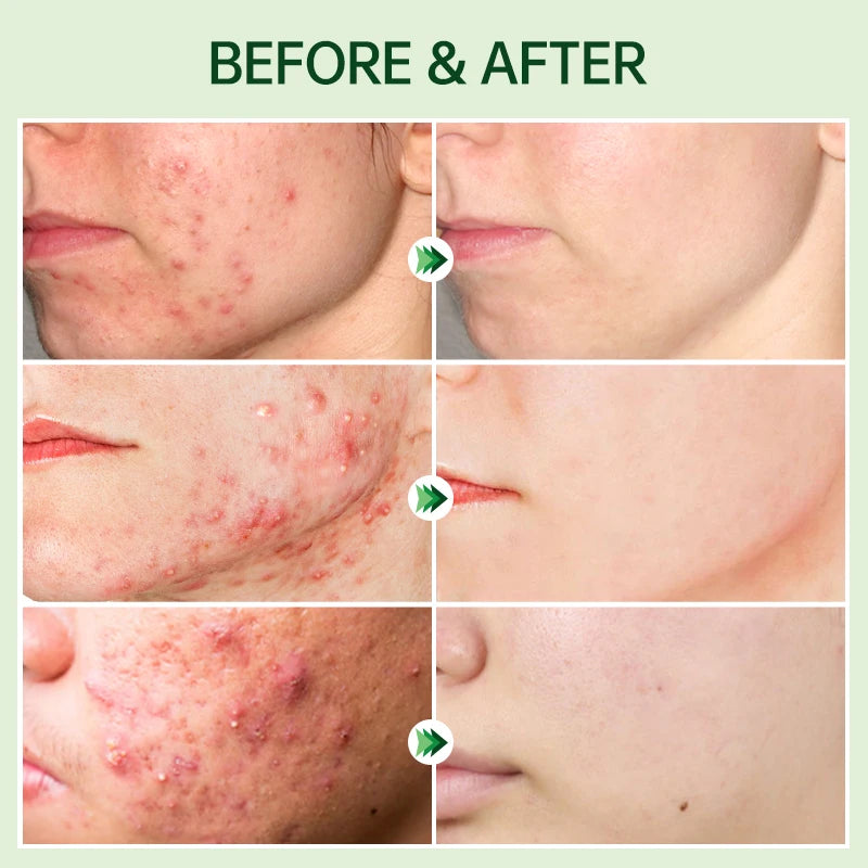 Salicylic Acid Acne Serum – Pore & Oil Control Treatment