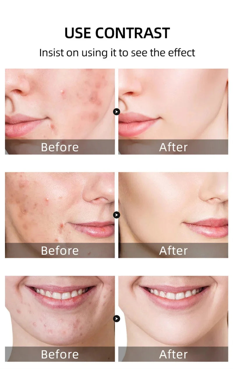 Acne Face Cream – Pimple Treatment & Oil Control Care