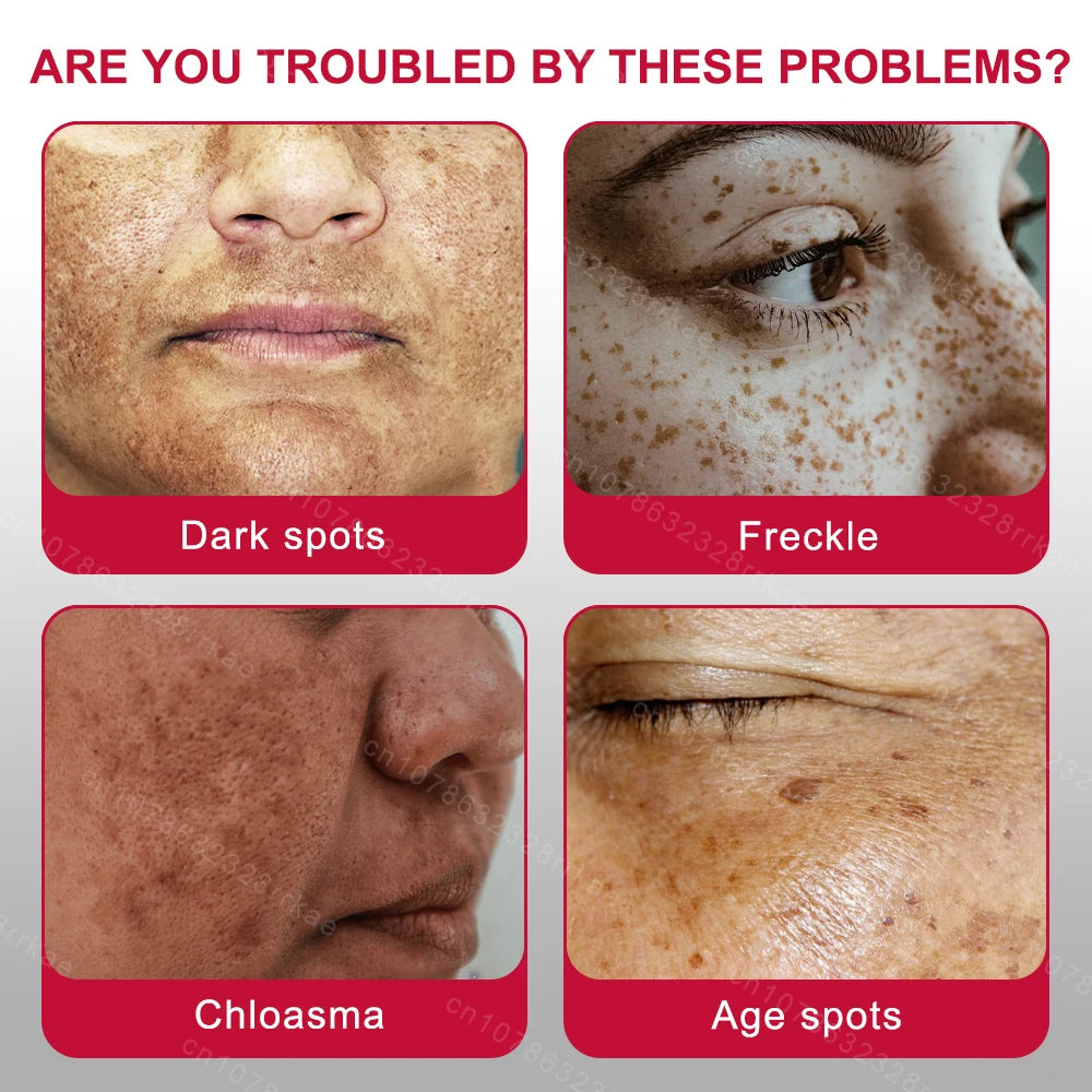 Whitening Freckle Cream – Dark Spot & Melasma Remover