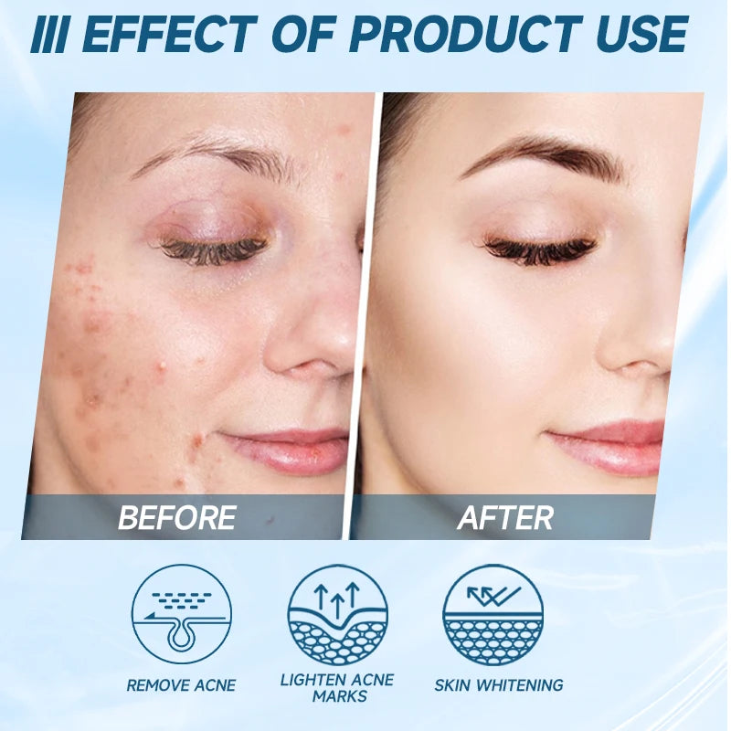 Oligopeptide Anti-Acne Serum – EGF Repair & Moisturizing