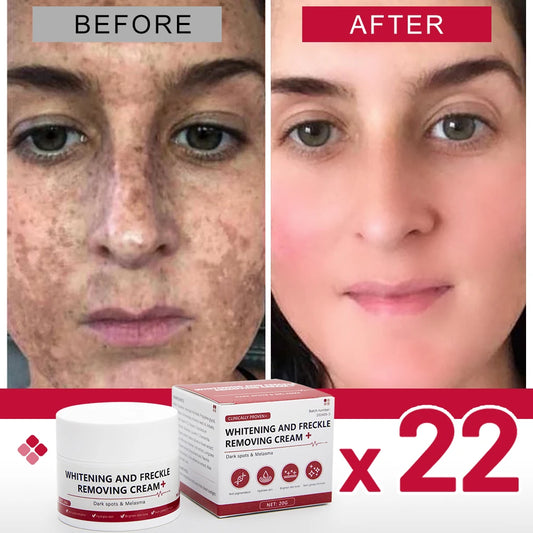 Whitening Freckle Cream – Dark Spot & Melasma Remover