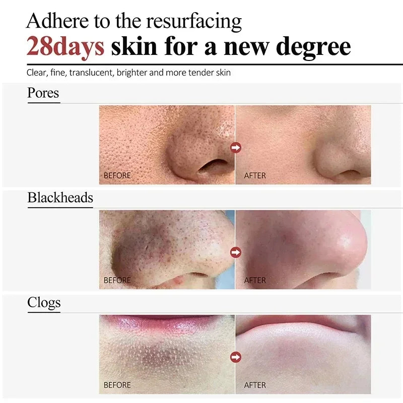 Salicylic Acid Pore Cream – Blackhead & Skin Repair Care