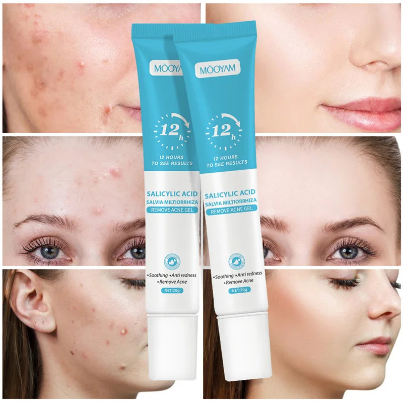 Acne Face Cream – Pimple Treatment & Oil Control Care