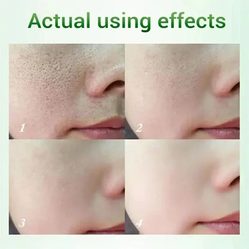 Salicylic Acid Pore Cream – Blackhead & Skin Repair Care