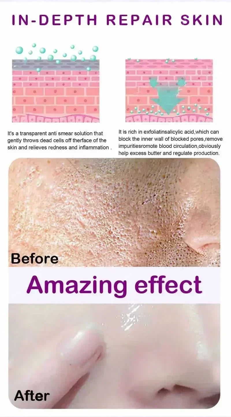 Facial Skin Peel Serum – Chemical Peel for Acne & Wrinkles