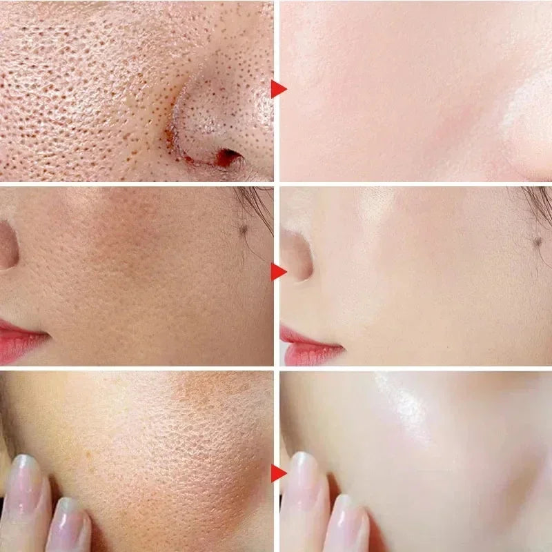 Salicylic Acid Pore Cream – Blackhead & Skin Repair Care