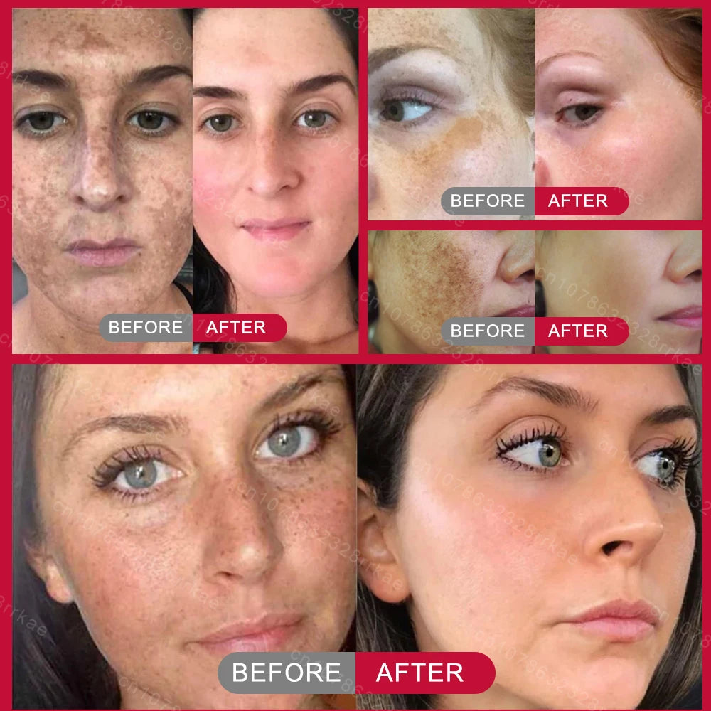 Whitening Freckle Cream – Dark Spot & Melasma Remover