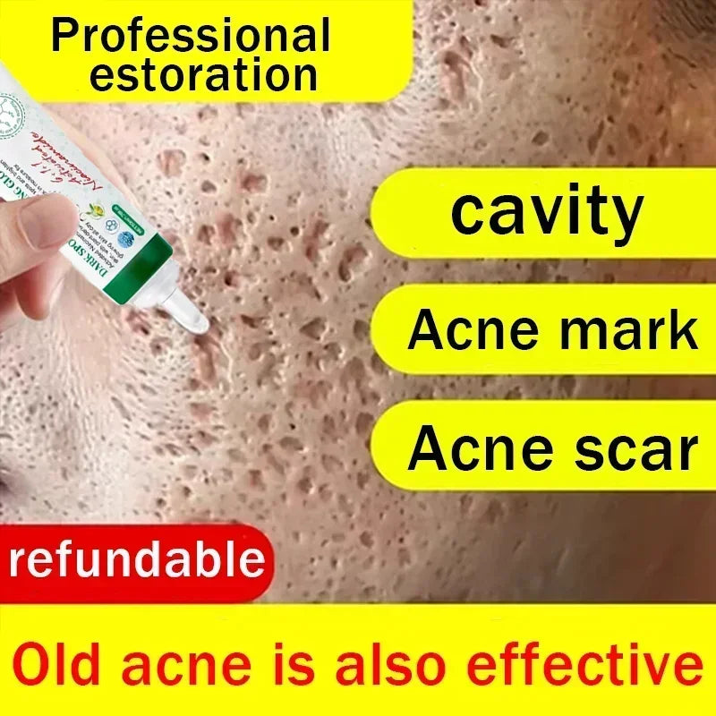 Men's Anti-acne Mark Pothole Repair Cream-Regeneration gel