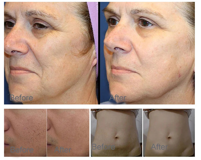 2-in-1 Plasma Skin Care Device – Hot & Cold Lifting Machine