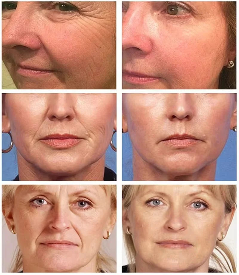 Retinol Wrinkle Remover Face Serum – Anti-Aging & Lifting