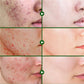 Salicylic Acid Acne Serum – Pore & Oil Control Treatment