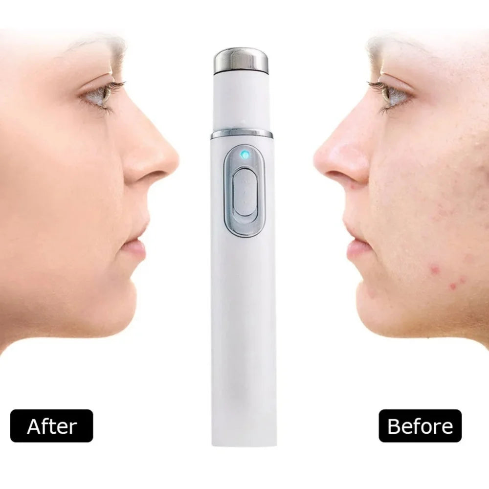 Blue Light Eye Massager Device For Dark Circles And Eyebag Relief