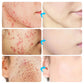 Acne Face Cream – Pimple Treatment & Oil Control Care