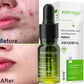 Salicylic Acid Acne Serum – Pore & Oil Control Treatment