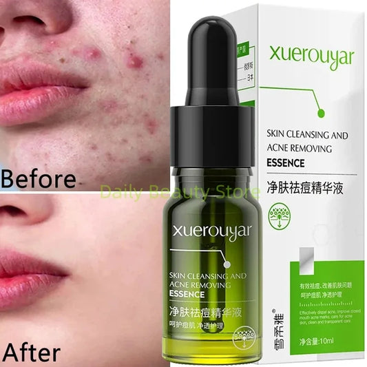 Salicylic Acid Acne Serum – Pore & Oil Control Treatment