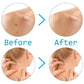 Skin Tag & Mole Removal Kit – Wart Remover with Swabs