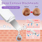 Ultrasonic Face Spatula – Blackhead & Pore Cleaner