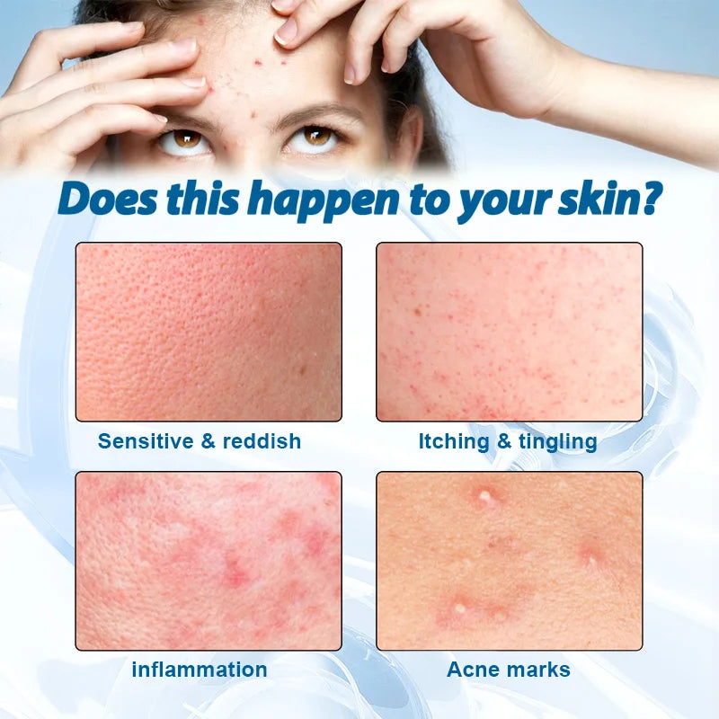 Oligopeptide Anti-Acne Serum – EGF Repair & Moisturizing