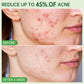 Salicylic Acid Acne Serum – Pore & Oil Control Treatment