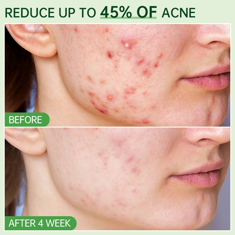 Salicylic Acid Acne Serum – Pore & Oil Control Treatment