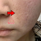 Men's Anti-acne Mark Pothole Repair Cream-Regeneration gel