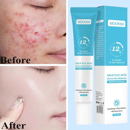 Acne Face Cream – Pimple Treatment & Oil Control Care