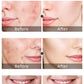 Acne Face Cream – Pimple Treatment & Oil Control Care