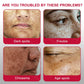 Whitening Freckle Cream – Dark Spot & Melasma Remover